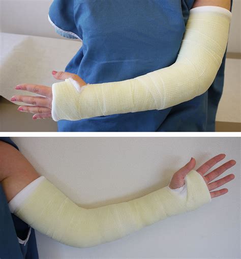 granny gets casted raw|Care of Casts and Splints .